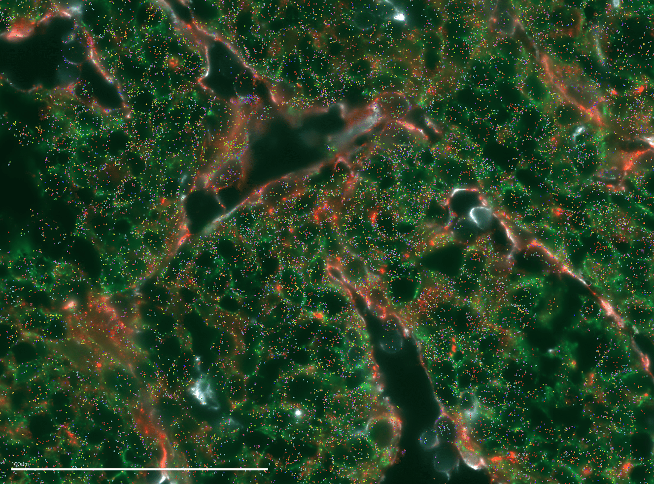 FIGURE 4: MERSCOPE data image of a human liver cancer tissue section with protein co-detection. Dots represent RNA transcripts: Goat Vimentin (light blue), Mouse-panCk (green), RabbitZo1 (red) protein expression.