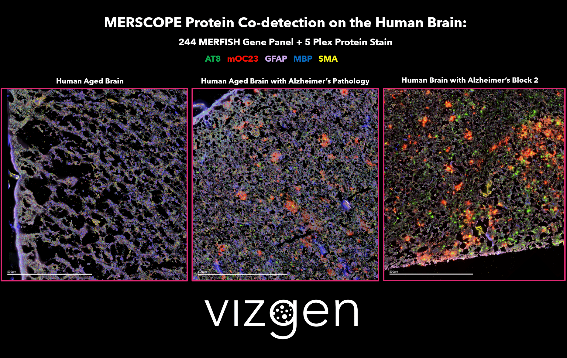 MERSCOPE Data Image showing the spatial multiomic differences between a normal human aged brain, and human brains with Alzheimer’s disease. The data image shows the spatial distribution of detected transcripts from 244 genes and 5 co-detected proteins across intact human brain tissue samples.